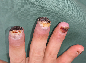 指尖部損傷１