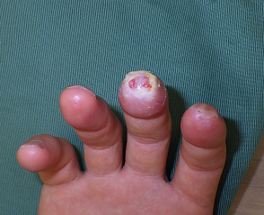 指尖部損傷５