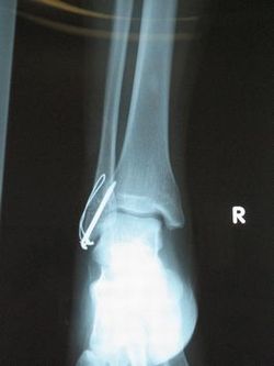 右足関節外果骨折レントゲン写真