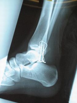 右足関節外果骨折レントゲン写真